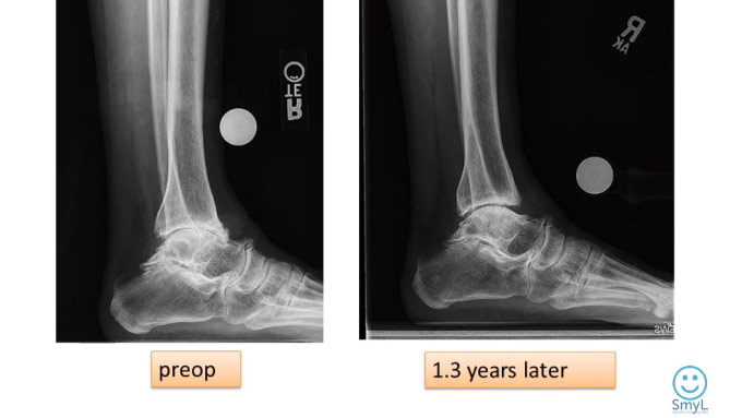 What is Ankle Arthritis?